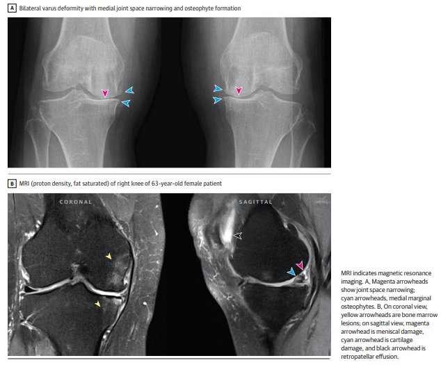 Revisão Em Osteoartrite