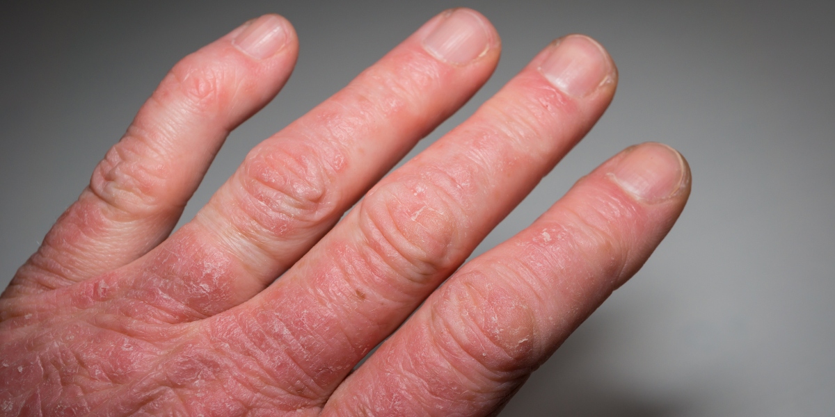 Artrite Psoriásica: Principais sintomas e como a inflamação afeta as articulações