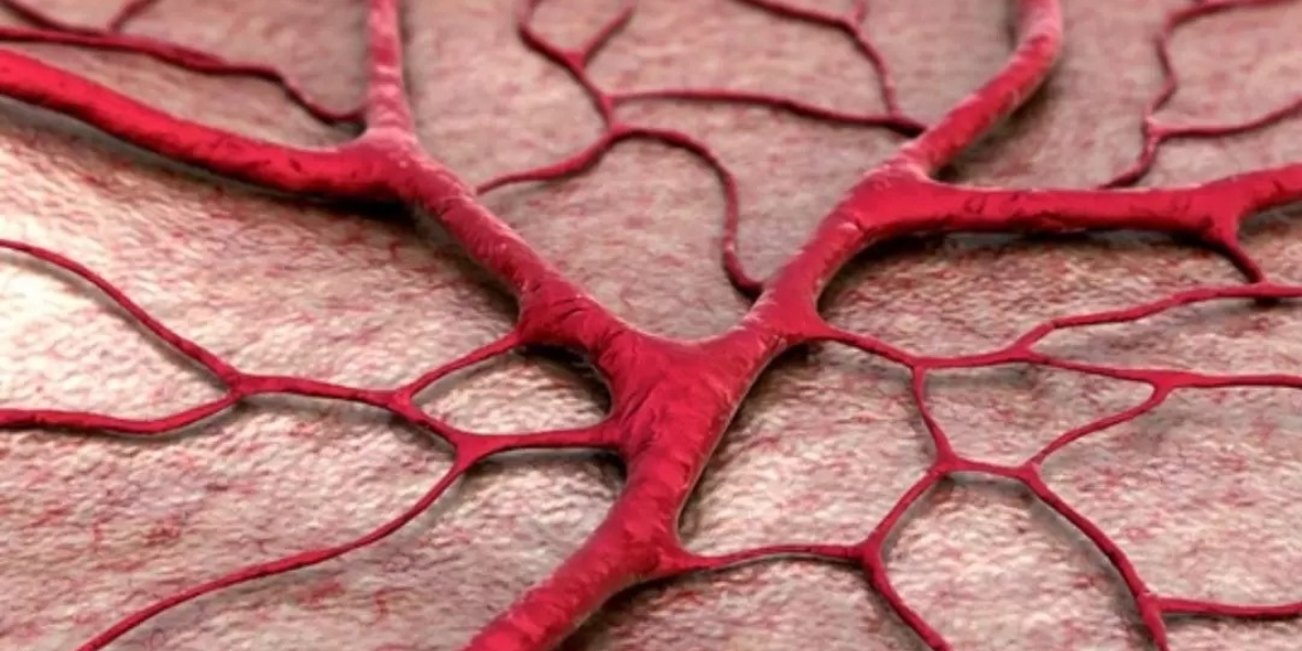Arterite de Células Gigantes