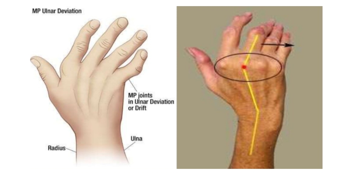 Mãos (Artropatia de Jaccoud)