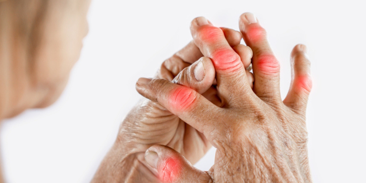 artrite psoriásica